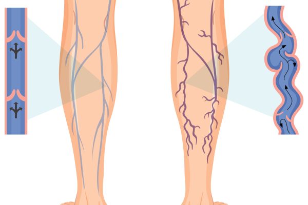 Human legs with varicose vein illustration