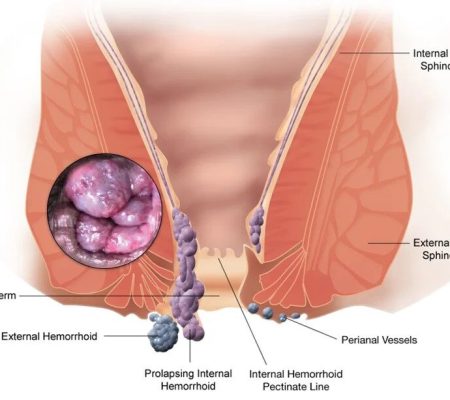 Hemorrhoids1