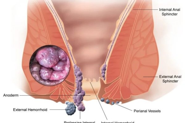 Hemorrhoids1